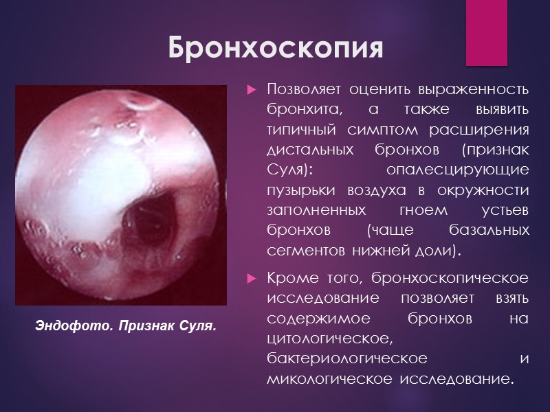 Бронхоскопия Позволяет оценить выраженность бронхита, а также выявить типичный симптом расширения дистальных бронхов (признак